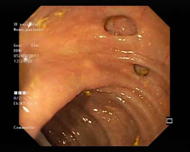 Diverticoli