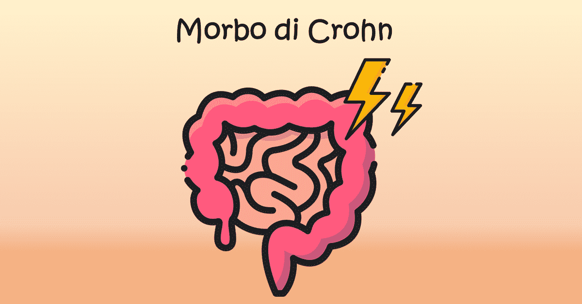 La malattia di Crohn